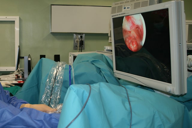 Cirugía Histeroscopia