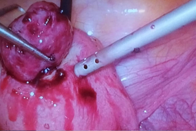 Extracción de miomas por laparoscopia